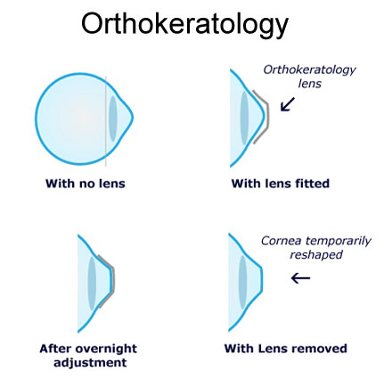 Orthokeratology: Principles, Lessons, Cases