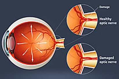 Don't Panic: Some Blurred Vision After LASIK Is Normal - LASIK Eye Surgery  Grand Junction, Cataracts Grand Junction CO